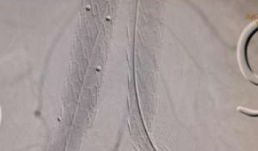 Closure of Aorto-Cameral Fistula